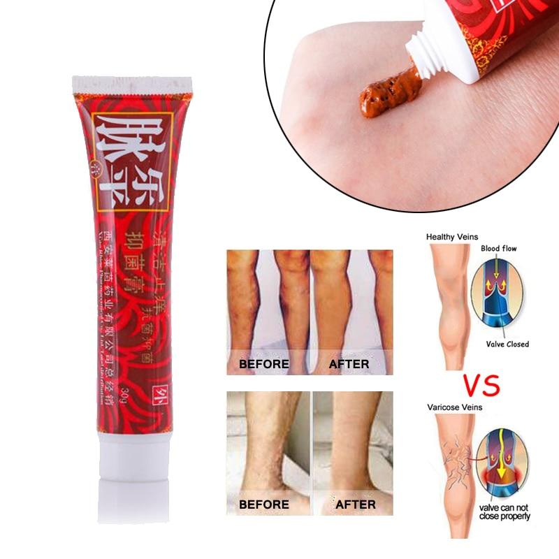 Varicose Veins Miracle Cream