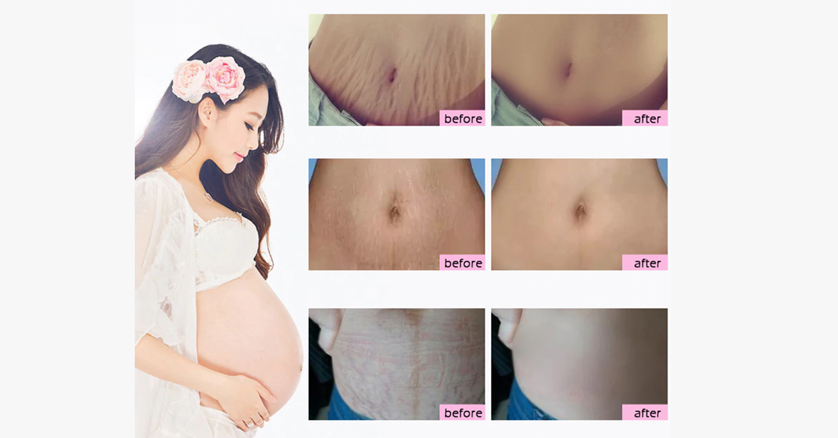 Pregnancy Scars and Stretch Mark Removal Cream