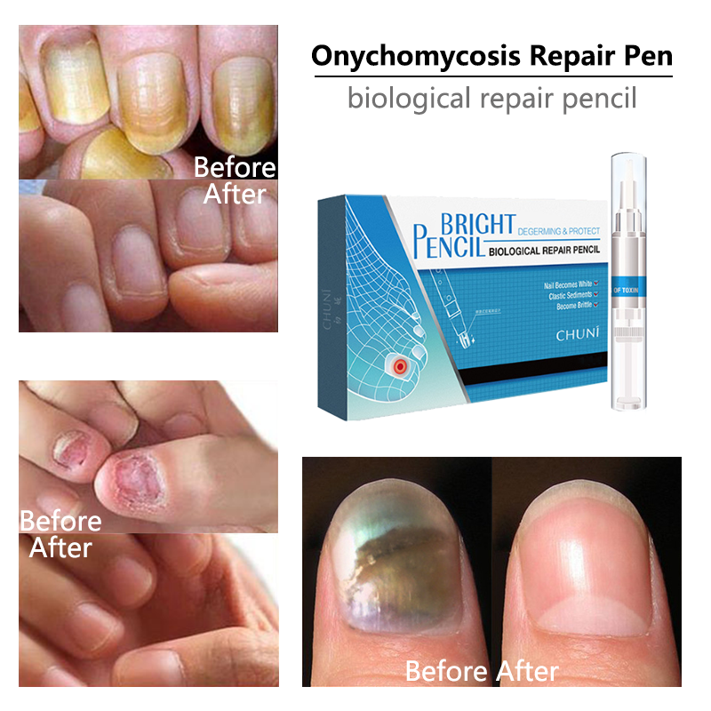 Onychomycosis Nail Repair Pen
