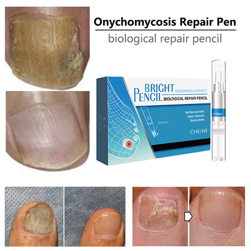 Onychomycosis Nail Repair Pen